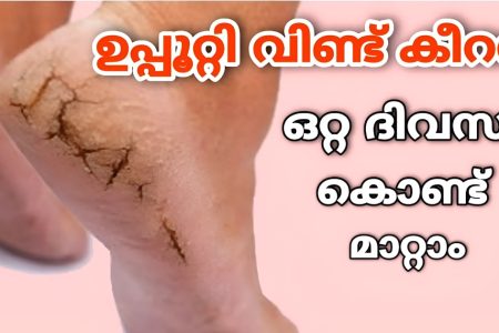 അത്ഭുത മരുന്ന്.!! കാൽ വിണ്ടു കീറൽ, വേദന സെക്കൻഡുകൾക്കുള്ളിൽ മാറ്റം; 100% നാച്ചുറൽ.!! 5 പൈസ ചിലവില്ല.. | Home Remedy For Cracked Heels